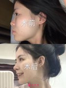 成都圣丹福整形醫(yī)院肋軟骨隆鼻案例，只做鼻子從此告別土氣臉
