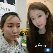 北京京民整形外科的雙眼皮修復(fù)案例，素顏化妝都很自然哦