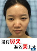 杭州格萊美汪云鋒醫(yī)生做的鼻綜合案例，重塑鼻尖美上天
