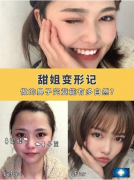 北京京民整形外科王志堅(jiān)醫(yī)生隆鼻案例，歪鼻子再也沒有了