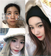 上海九院隆鼻王濤醫(yī)生做的鼻綜合，解決了鼻子寬鼻孔不對稱問題
