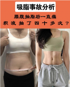 重慶軍美武劍醫(yī)生做的腰腹吸脂手術，術后半年效果