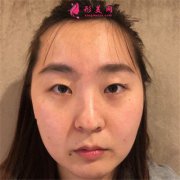 濟南海峽美容整形醫(yī)院眼部綜合手術術后效果展示