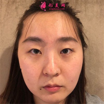 濟南眼部綜合手術(shù)術(shù)后效果展示