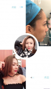 北京知音醫(yī)療美容李奇軍醫(yī)生做的鼻綜合隆鼻案例