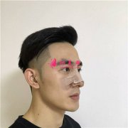 南京華美美容醫(yī)院小哥哥鼻部修復術后效果反饋