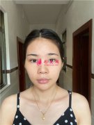 北京潤美玉之光吸脂瘦臉術后恢復情況對比
