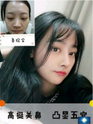 上海九院王濤醫(yī)生鼻部多項(xiàng)案例，鼻綜合讓五官更加精致