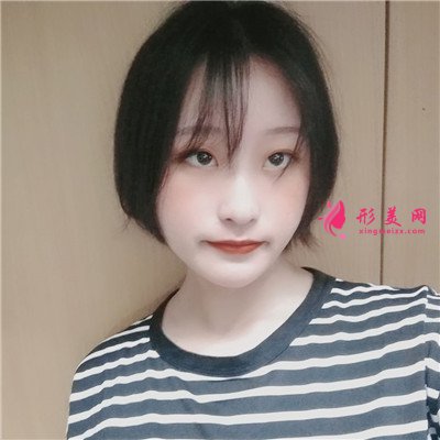 深圳內切祛眼袋術后恢復情況對 術后 深圳內切祛眼袋術后恢復情況對