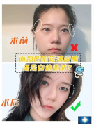 北京韓嘯院長全臉脂肪案例，面部凹陷選玻尿酸還是自體脂肪？