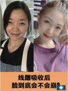 重慶軍美龍燕玲醫(yī)生做的埋線提升案例，線雕被吸收后臉會崩？