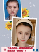 北京聯(lián)合麗格何照華醫(yī)生做的下頜角截骨+顴骨顴弓縮小術(shù)案例分享