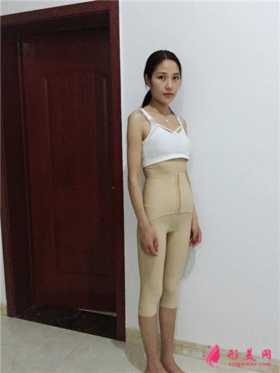 北京全身吸脂手術(shù)術(shù)后恢復(fù)情況分享