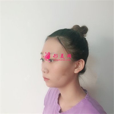 河南彩光嫩膚術(shù)后恢復(fù)效果展示
