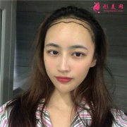 重慶種植發(fā)際線手術(shù)術(shù)后效果分享