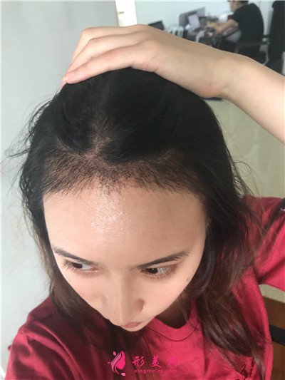 重慶種植發(fā)際線手術(shù)術(shù)后效果分享 術(shù)后 重慶種植發(fā)際線手術(shù)術(shù)后效果分享