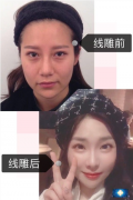 重慶軍美龍燕玲醫(yī)生做的埋線提升案例，線雕副作用多嗎？