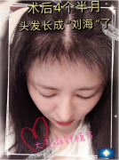 大麥微針植發(fā)4個(gè)半月,移植發(fā)際線長(zhǎng)成了劉海