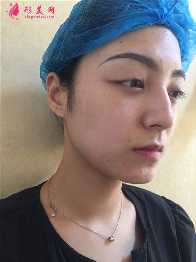 成都小姐姐全切雙眼皮術(shù)后恢復(fù)效果展示