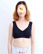北京麗都整形醫(yī)院假體隆胸案例 從A變C的喜悅您能體會(huì)嗎?