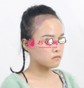 重慶華美整形醫(yī)院植發(fā)科發(fā)際線種植對(duì)比圖