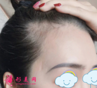 廣州華美植發(fā)整形醫(yī)院發(fā)際線種植分享 這效果我愛(ài)了