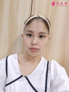 北大口腔醫(yī)院李自力正頜怎么樣？醫(yī)生案例效果圖~恢復(fù)心得一覽