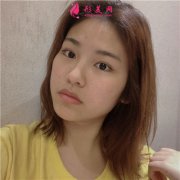 四川華人醫(yī)聯(lián)整形美容醫(yī)院小姐姐面部吸脂術(shù)后恢復(fù)情況分享