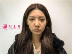 深圳鵬程醫(yī)院硅膠假體隆鼻術(shù)后恢復(fù)效果反饋