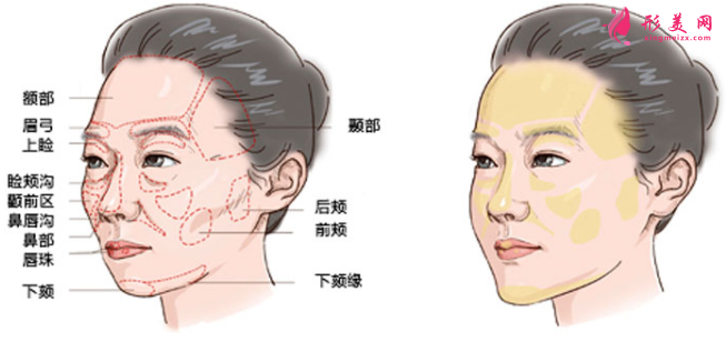自體脂肪填充臉部一般要做多少次