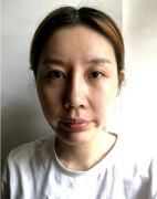 鄭州華領(lǐng)醫(yī)療美容醫(yī)院做的鼻子，隆鼻后感覺(jué)自己越來(lái)越年輕了