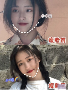 重慶軍美武劍醫(yī)生做的面部吸脂手術(shù)，重塑面部輪廓