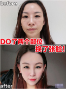南京美貝爾陳剛醫(yī)生做的綜合隆鼻，只DO了鼻部多項(xiàng)+全臉脂肪填