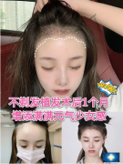 上海九院做的發(fā)際線移植，發(fā)際線是很都女神都有的問