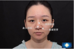 廣州廣大整形美容醫(yī)院做的隆鼻修復(fù)案例，這是第3次做鼻子了