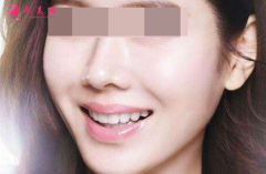 自體脂肪填充臉部腫脹明顯嗎