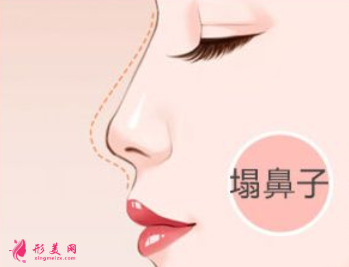 自體軟骨隆鼻術(shù)后效果多久穩(wěn)定
