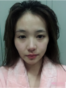  北京潤(rùn)美玉之光自體脂肪全臉填充怎么樣？附填充案例前后對(duì)比