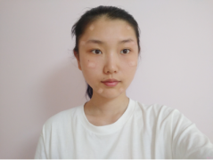 北京純脂醫(yī)療美容自體脂肪填充全臉怎么樣？