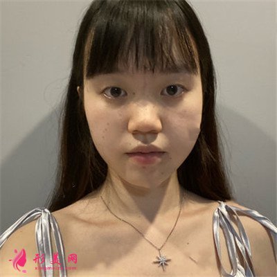 北京眼部綜合手術(shù)術(shù)后恢復(fù)效果對(duì)比