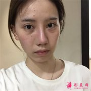 杭州華山連天美膨體隆鼻術(shù)后案例分享