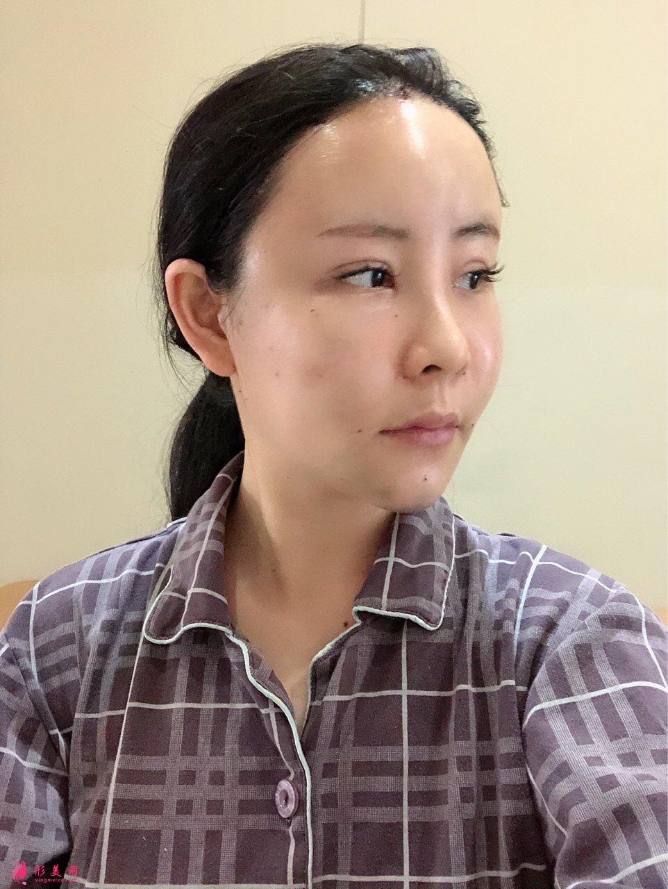 上海美萊醫(yī)療美容價(jià)格表，附自體脂肪豐額頭案例分享