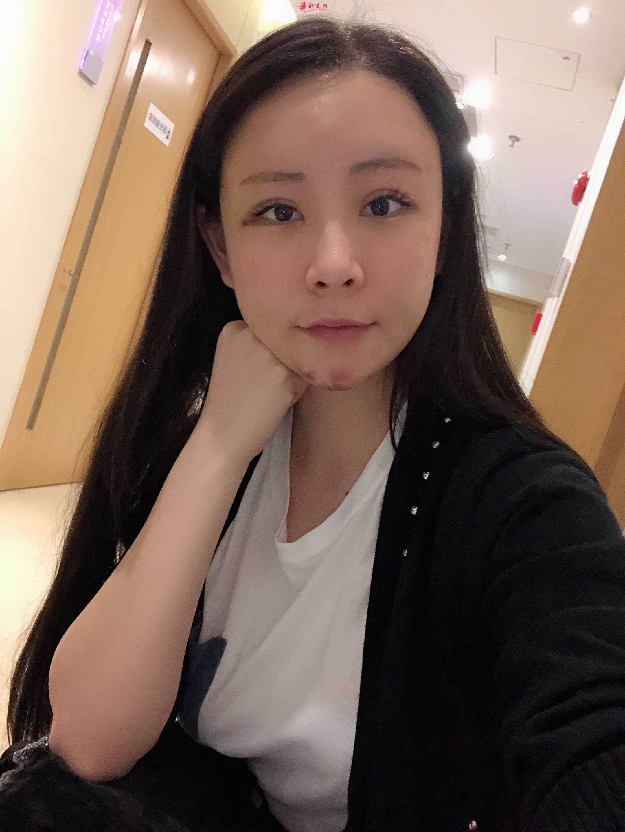 上海美萊醫(yī)療美容價(jià)格表，附自體脂肪豐額頭案例分享