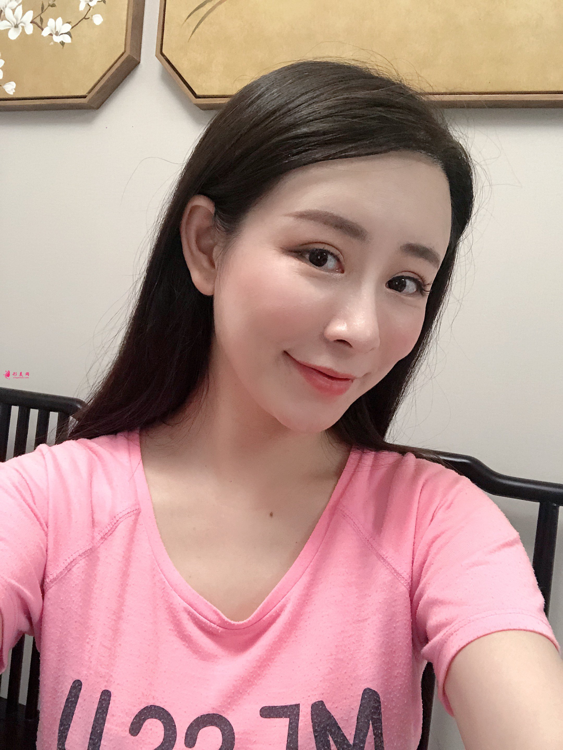 上海美萊醫(yī)療美容價(jià)格表，附自體脂肪豐額頭案例分享