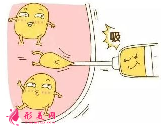腰腹部吸脂大概需要多少錢