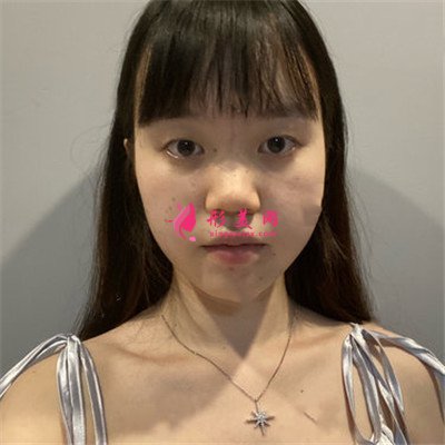 北京眼部綜合手術(shù)術(shù)后恢復效果對比