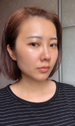 上海華美醫(yī)療美容醫(yī)院怎么樣，附玻尿酸墊下巴案例