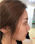 南京華美曹海峰鼻部案例分享