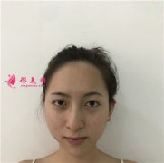 南京新生植發(fā)醫(yī)院種植發(fā)際線術(shù)后恢復(fù)情況對(duì)比