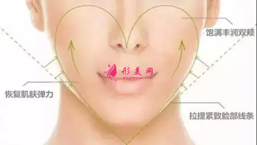自體脂肪填充臉部的效果可以保持多久